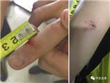 龙港首起袭警案！女子酒后咬伤民警被刑拘！