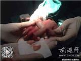 切菜不慎断两指 医生妙手巧再植