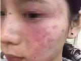 朋友圈的东西不要乱用 温州一美女几乎被毁容