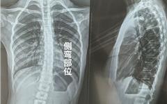 11岁女孩脊柱侧弯15度 11天体态养护后影像对比向好 家长分享经历提醒重视筛查