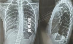 11岁女孩脊柱侧弯15度 11天体态养护后影像对比向好 家长分享经历提醒重视筛查