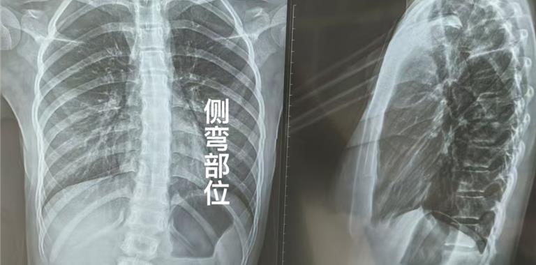 11岁女孩脊柱侧弯15度 11天体态养护后...